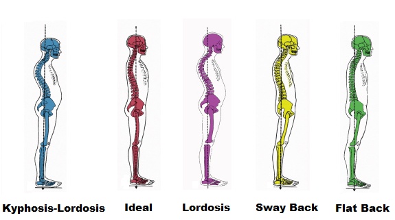 What is your natural spinal posture? � Cardiff Physio
